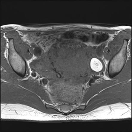 Ovarian dermoid cyst | Radiology Case | Radiopaedia.org