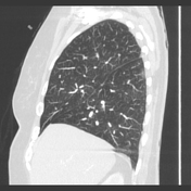 polysplenia | Search | Radiopaedia.org