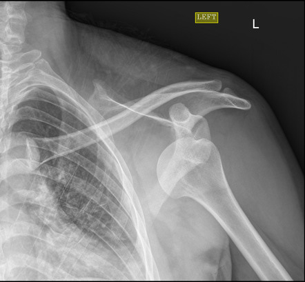 Left anterior shoulder dislocation | Radiology Case | Radiopaedia.org