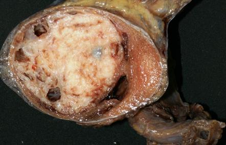 Non-seminomatous germ cell tumors | Radiology Reference Article