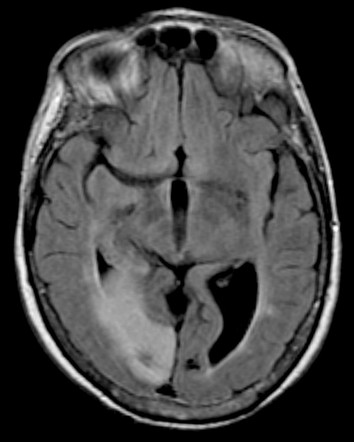 posterior cerebral artery territory