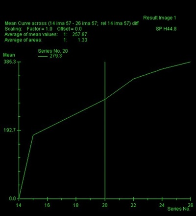 Breast MRI enhancement curves | Radiology Reference Article ...