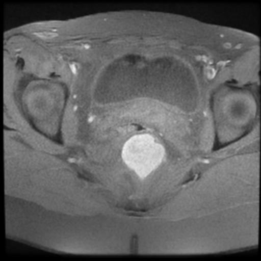 Tailgut duplication cyst | Image | Radiopaedia.org