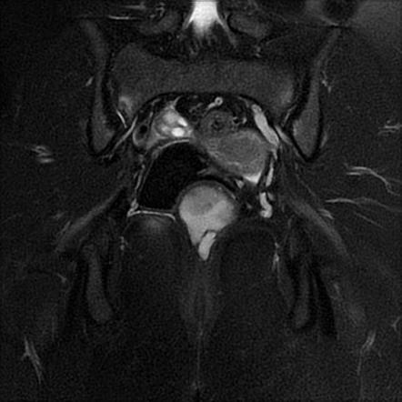 Tailgut duplication cyst | Image | Radiopaedia.org