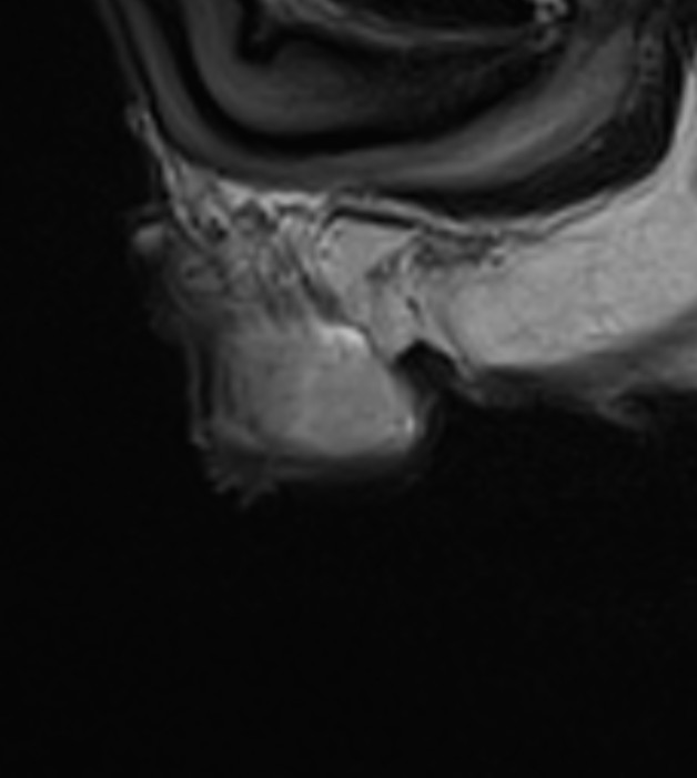 Testicular Adrenal Rest Tumor Tart Image