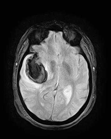 Intrasylvian hematoma | Radiology Case | Radiopaedia.org