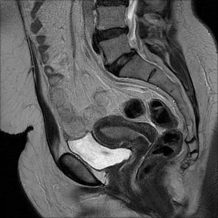 Endometrial adenocarcinoma | Radiology Case | Radiopaedia.org