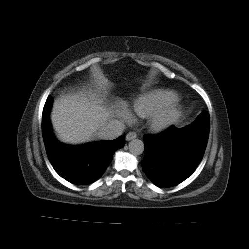 Morgagni hernia | Image | Radiopaedia.org