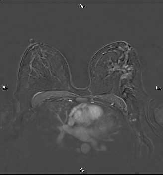 Breast mass (BI-RADS 5) | Image | Radiopaedia.org