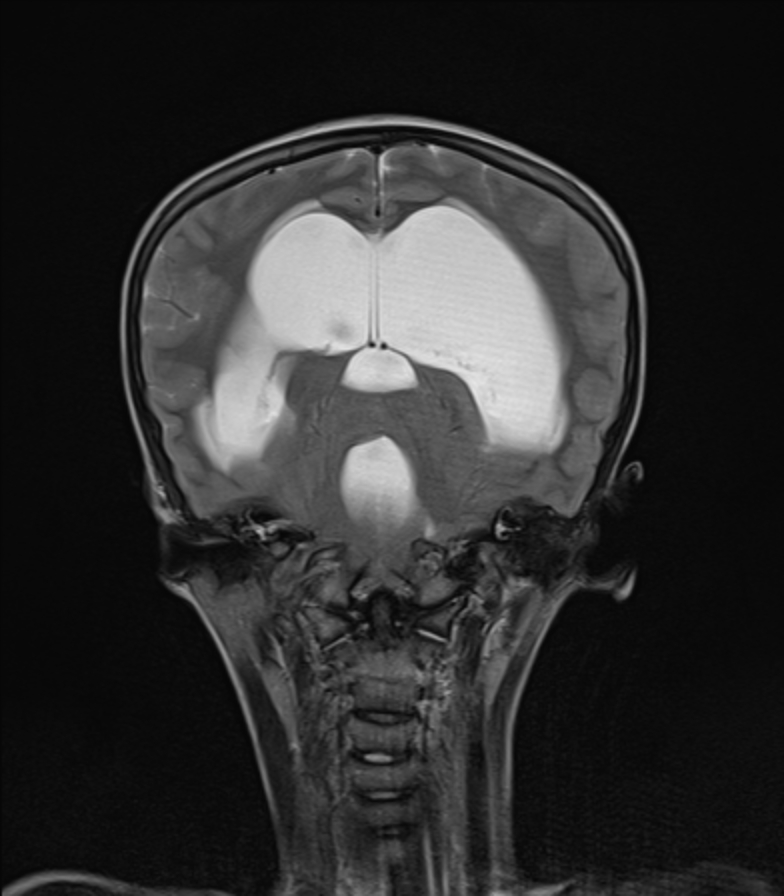 Dandy Walker Malformation Image