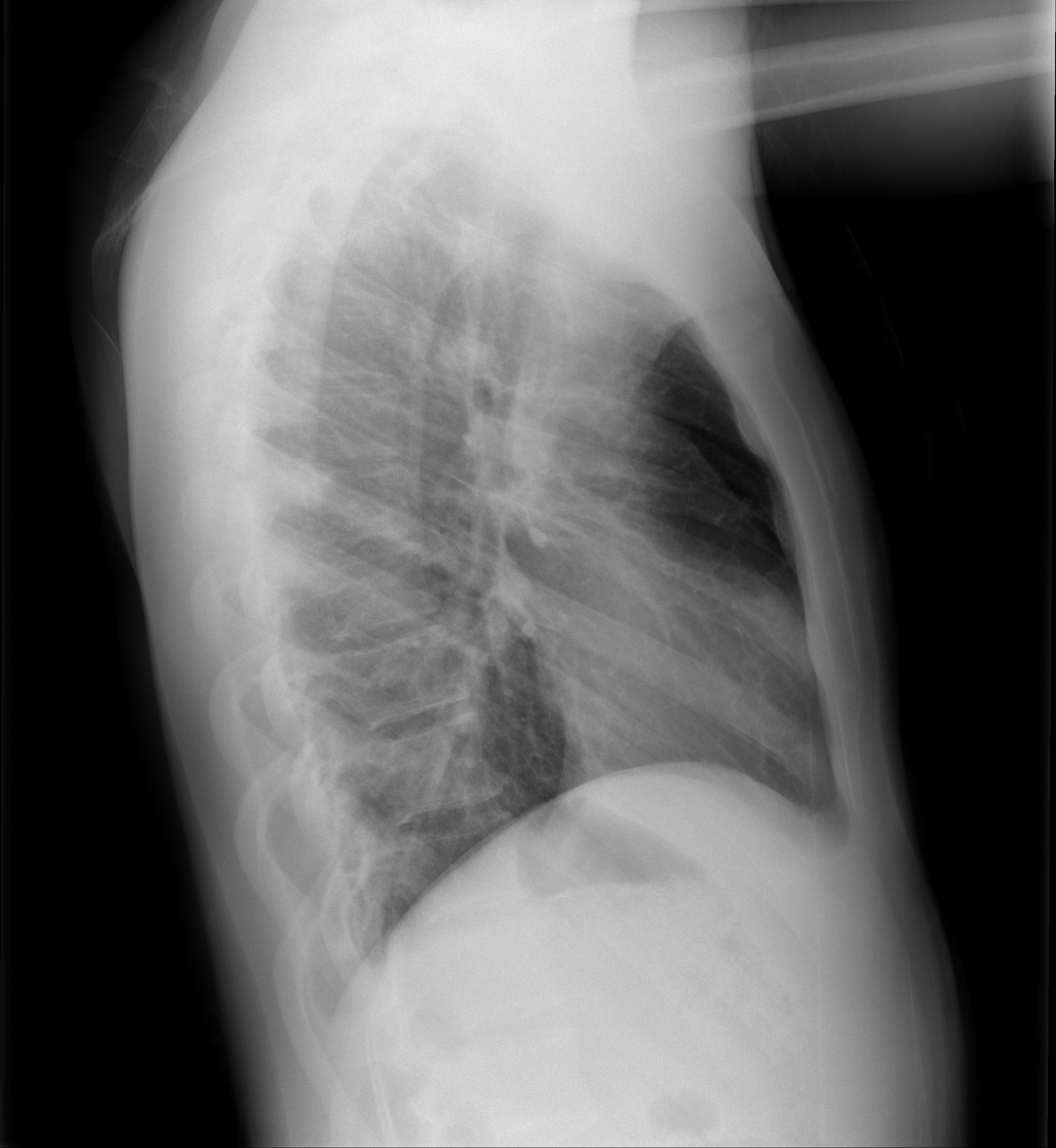 Pulmonary septic emboli | Image | Radiopaedia.org