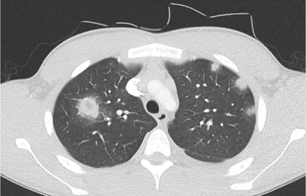 Pulmonary septic emboli | Radiology Case | Radiopaedia.org