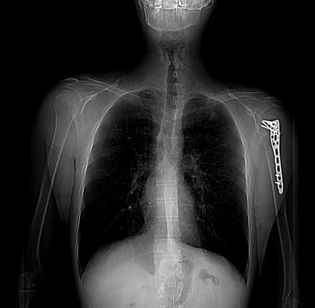 Pulmonary hamartoma | Radiology Case | Radiopaedia.org