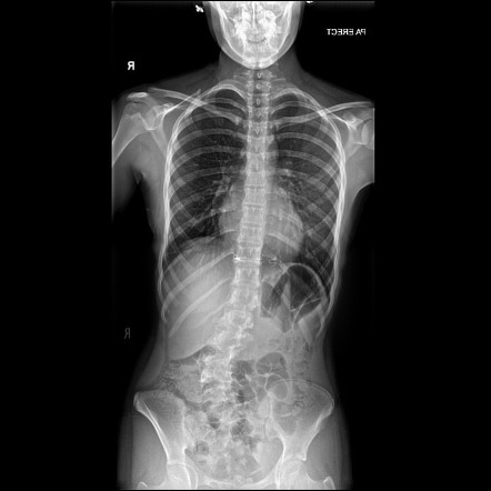 Congenital scoliosis | Radiology Reference Article | Radiopaedia.org