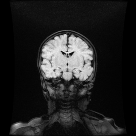 radiopaedia myelination multicystic encephalomalacia