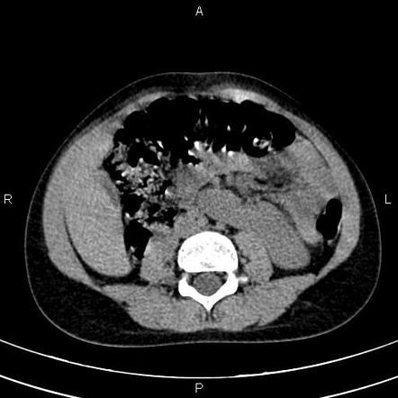 Crossed fused renal ectopia | Radiology Case | Radiopaedia.org