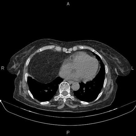 Morgagni hernia | Radiology Reference Article | Radiopaedia.org