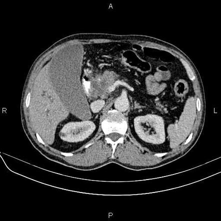 Pancreatic cancer | Radiology Case | Radiopaedia.org