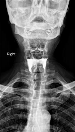 Barium Aspiration | Image | Radiopaedia.org