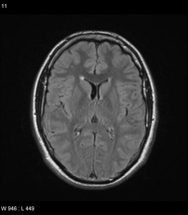 Transependymal edema | Radiology Reference Article | Radiopaedia.org