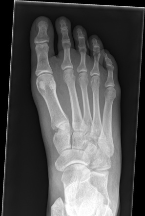 Midfoot fractures | Radiology Case | Radiopaedia.org