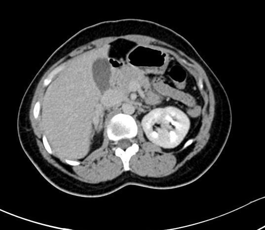 Adrenal adenoma | Image | Radiopaedia.org