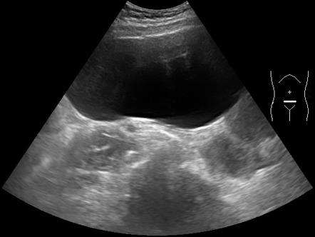 Ovarian serous cystadenofibroma | Radiology Case | Radiopaedia.org