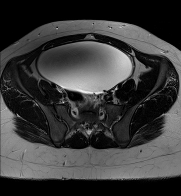 Ovarian serous cystadenofibroma | Image | Radiopaedia.org