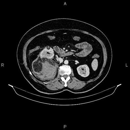 Renal angiomyolipoma | Radiology Case | Radiopaedia.org