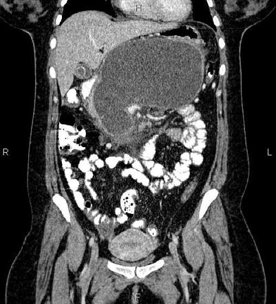 Pancreatic Pseudocyst 