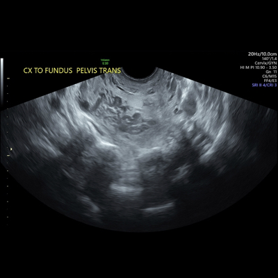 cord presentation ultrasound