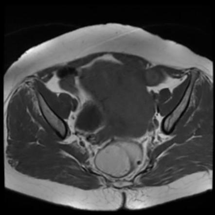 Uterine leiomyosarcoma | Image | Radiopaedia.org