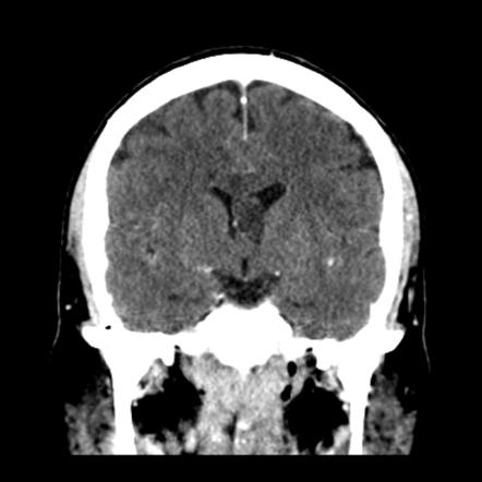 Subependymoma | Radiology Reference Article | Radiopaedia.org