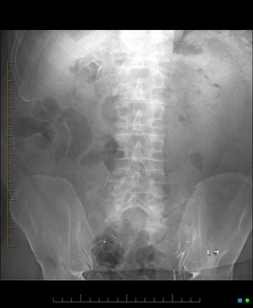 Ileal conduitogram | Radiology Case | Radiopaedia.org