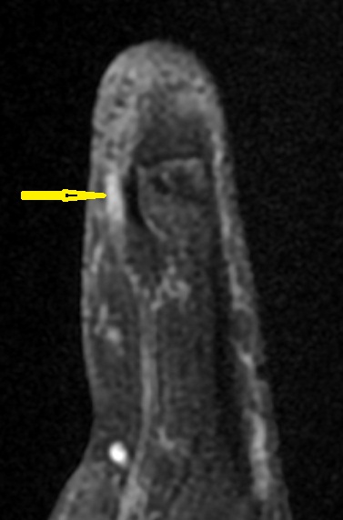 Stump neuroma - hand | Image | Radiopaedia.org