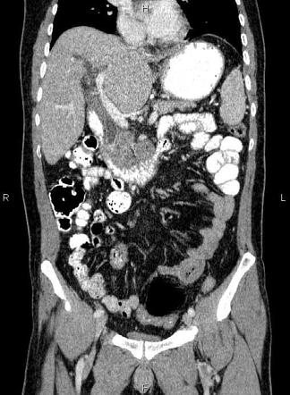 Pancreatic ductal adenocarcinoma | Radiology Reference Article ...