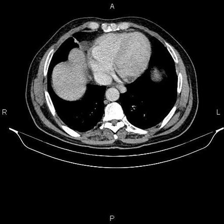 Pericardial cyst | Radiology Reference Article | Radiopaedia.org