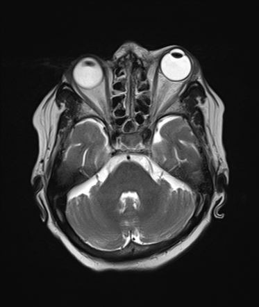 Orbital cellulitis with superior ophthalmic vein thrombosis | Radiology ...