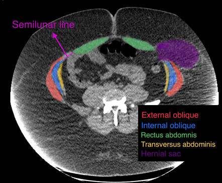 right lower quadrant spigelian hernia icd 10