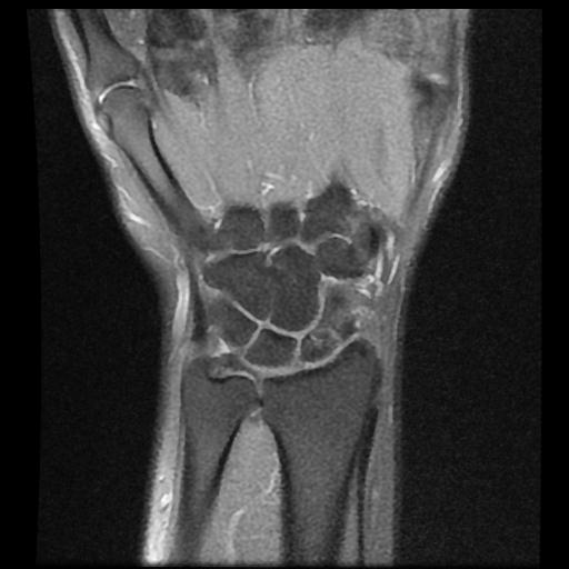 Scaphoid nonunion with humpback deformity | Image | Radiopaedia.org