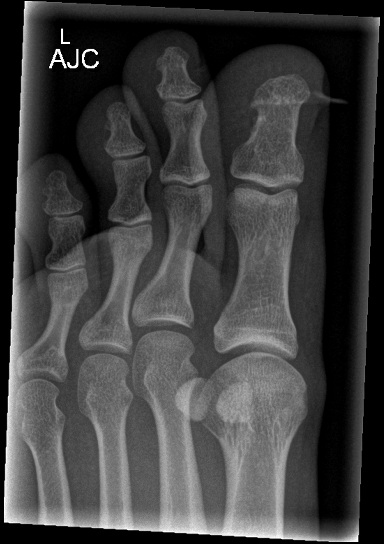 Avulsion of hallux toe nail | Image | Radiopaedia.org