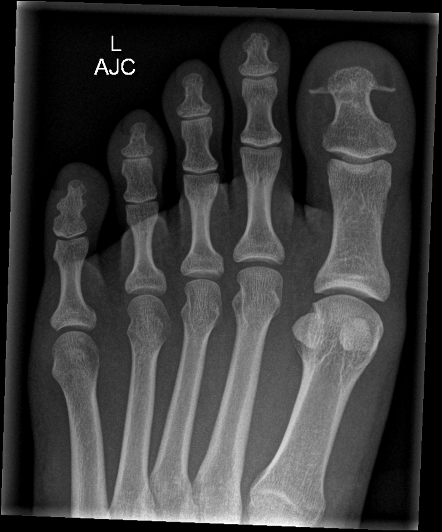 Avulsion of hallux toe nail | Image | Radiopaedia.org