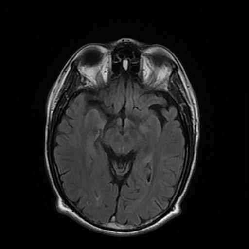 Cerebral Venous Thrombosis With Secondary Intracranial Hypertension