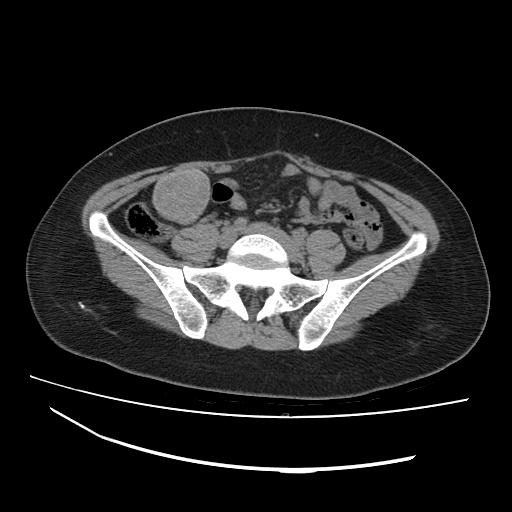 Gossypiboma | Image | Radiopaedia.org