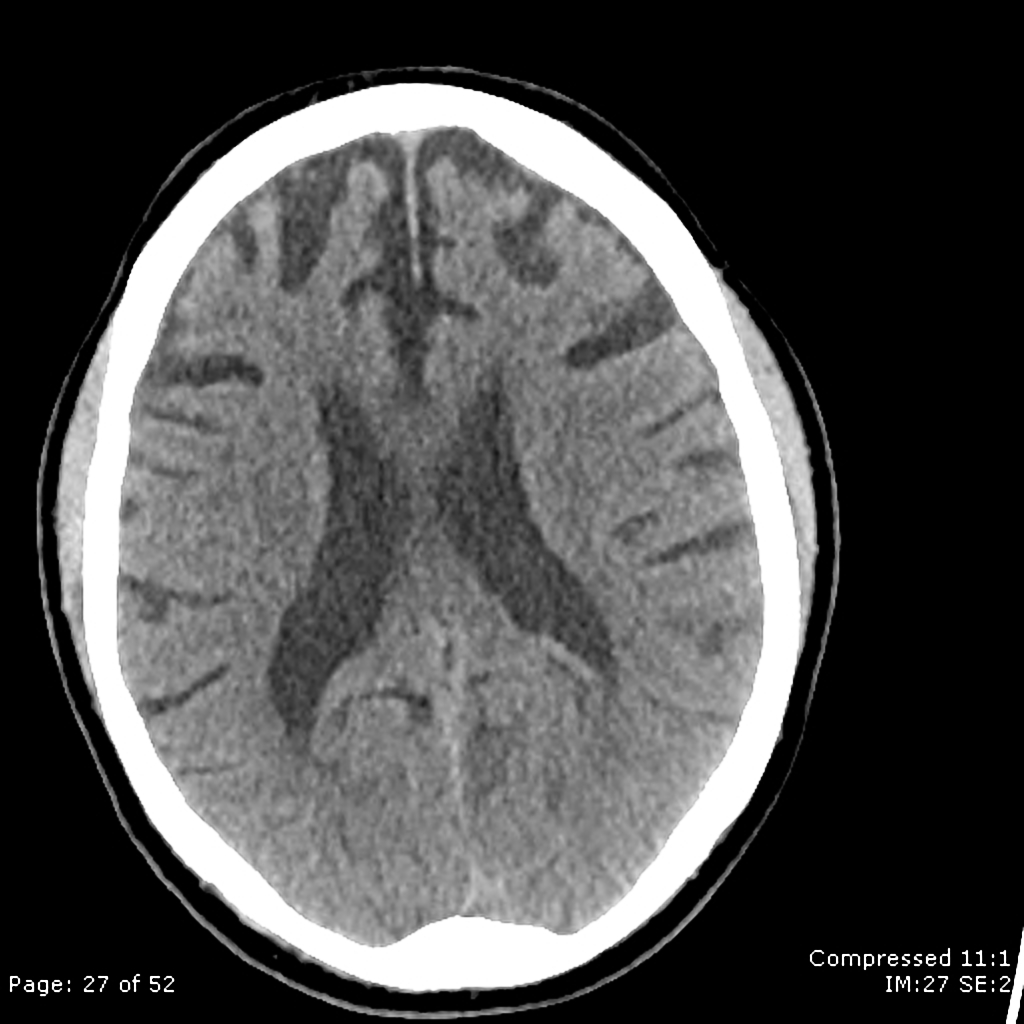 Frontotemporal Dementia Radiopaedia