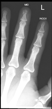 Distal phalanx fracture | Radiology Case | Radiopaedia.org