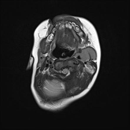 Ectopic thymus (left neck lump) | Image | Radiopaedia.org