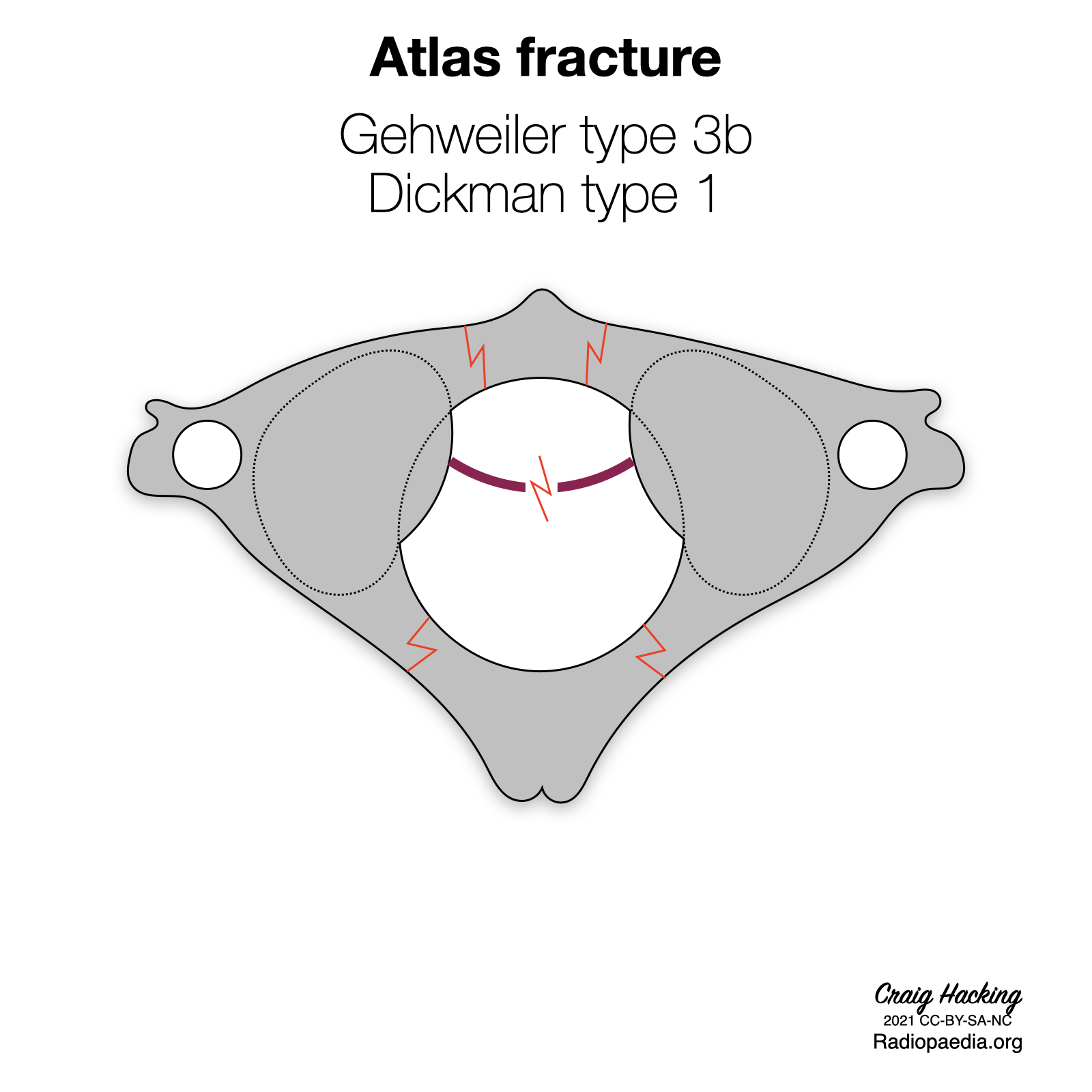 Gehweiler classification of atlas fractures (diagrams) | Image 