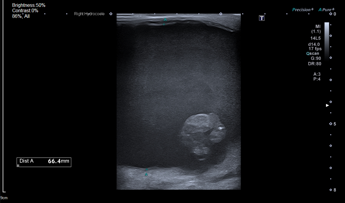 Hematocele Ultrasound