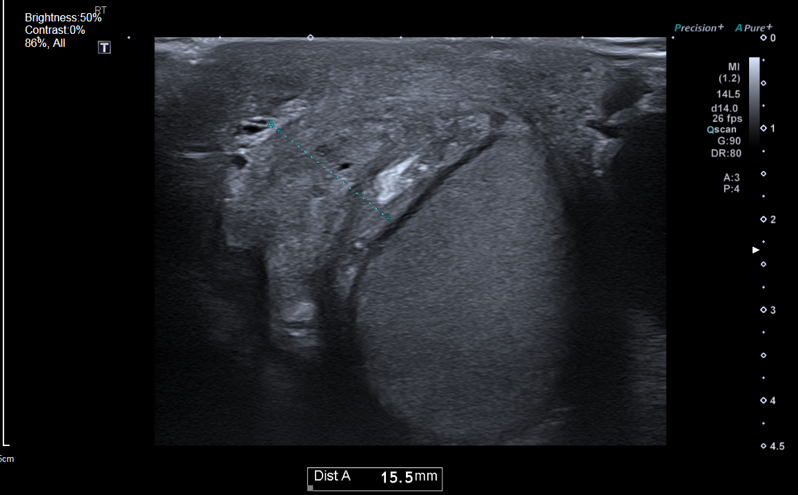 Hematocele Postoperative Testicular Ultrasound Image